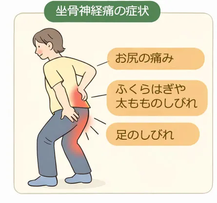 お尻が痛い、足のしびれの坐骨神経痛の症状のイラスト